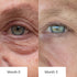 Before_And_After_Showcasing_Improvement_In_Skin_Texture_Around_The_Eye_After_3_Months